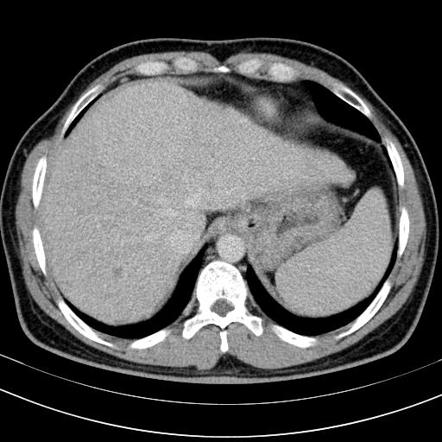 Macroregenerative siderotic hepatic nodule | Image | Radiopaedia.org