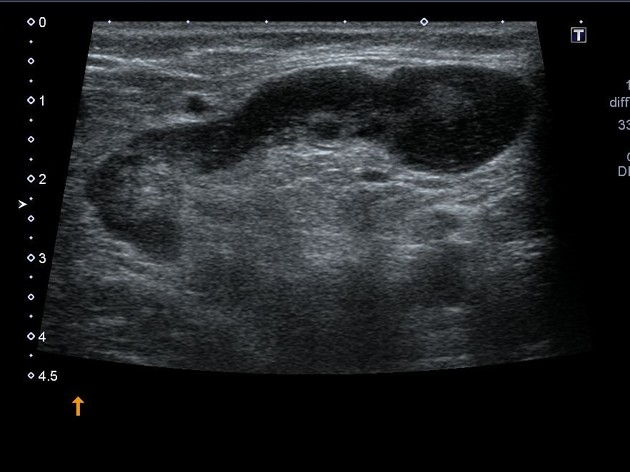 RadioGraphics on X: A groin lump is not uncommon in girls and