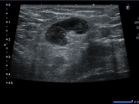 Groin Lymph Node Ultrasound