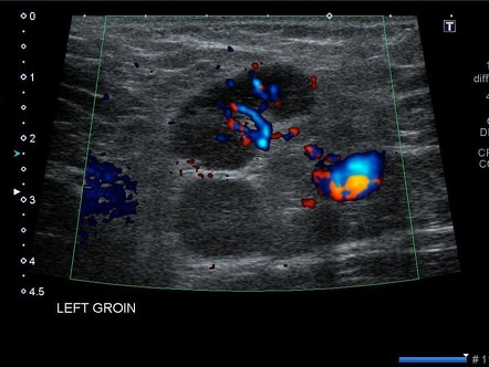 Reactive groin lymph node | Image | Radiopaedia.org