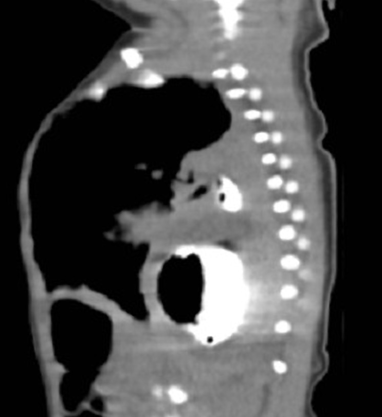 Congenital Diaphragmatic And Perineal Hernias Image Radiopaedia Org