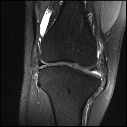 Congenital absence of anterior cruciate ligament | Radiology Case ...