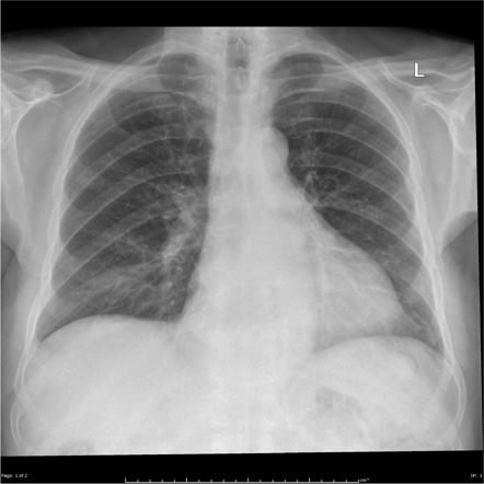 Hiatus hernia | Radiology Case | Radiopaedia.org