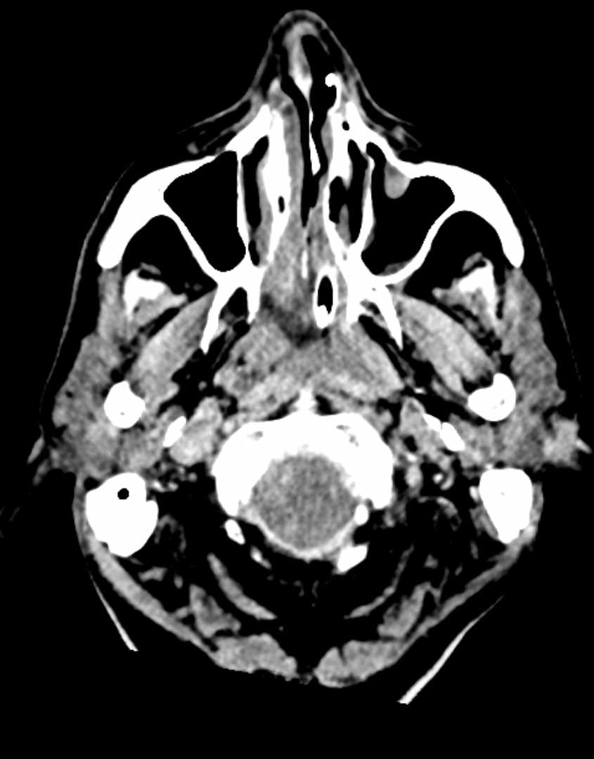 FDM Training Center - #Repost @med.case • • • • • • The #steeple sign (some  may call it pencil sign ✏️) is a radiologic sign found on a frontal neck  radiograph