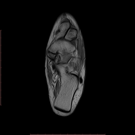 navicular accessory radiopaedia