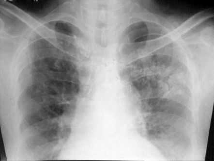 Metastatic Pulmonary Calcification Radiology Reference Article Radiopaedia Org