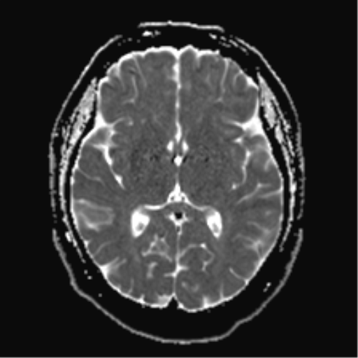 Multiple sclerosis (DWI) | Image | Radiopaedia.org