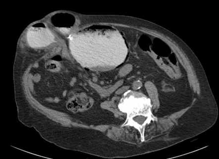 Gastric emphysema due to strangulation | Radiology Case | Radiopaedia.org