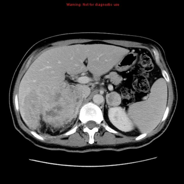 Adrenal adenoma | Radiology Reference Article | Radiopaedia.org