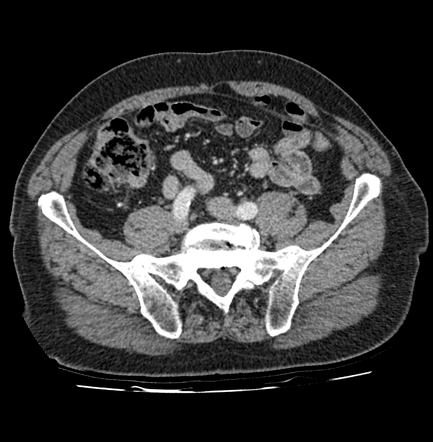 Posterior rectus sheath hernia | Radiology Case | Radiopaedia.org