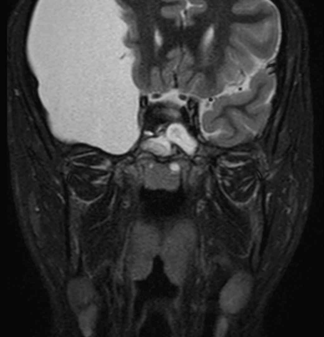 Arachnoid Cyst: Extremely Large 