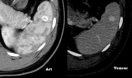 Splenic Lesions And Anomalies | Radiology Reference Article ...