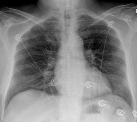 Azygo-esophageal recess | Radiology Reference Article | Radiopaedia.org