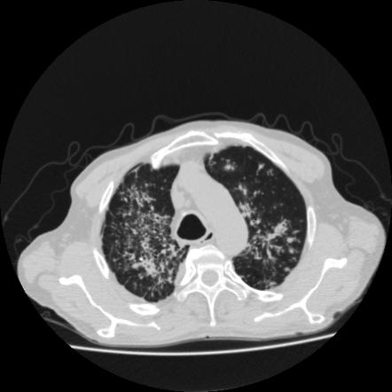 Tuberculosis (pulmonary Manifestations) | Radiology Reference Article ...