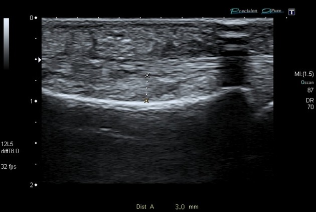 Finger pulley injury | Radiology Reference Article | Radiopaedia.org