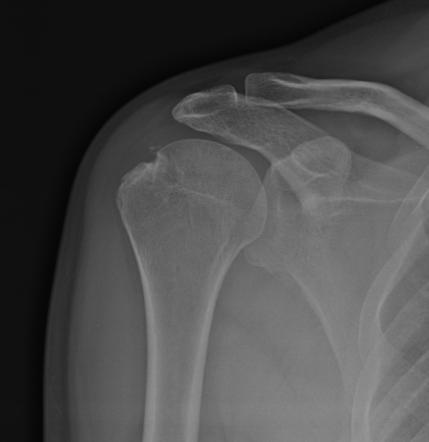 Avulsion of greater tuberosity of humerus | Radiology Case ...