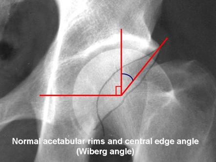 Center edge angle of Wiberg | Radiology Reference Article | Radiopaedia.org