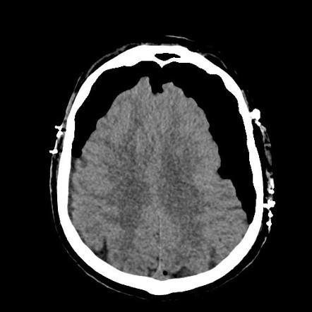 Tension Pneumocephalus Radiology Case Radiopaedia Org