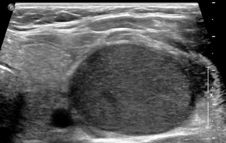 branchial cleft cyst ultrasound