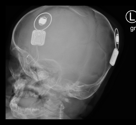 Cochlear implants - bilateral | Image | Radiopaedia.org