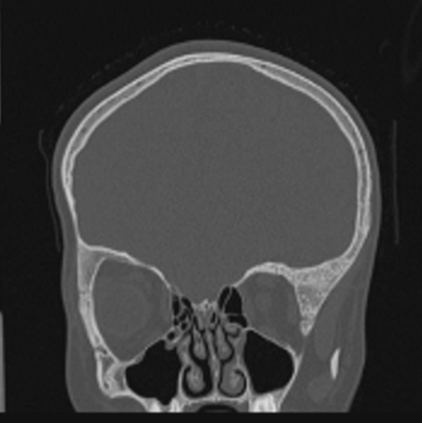 Plagiocephaly | Image | Radiopaedia.org