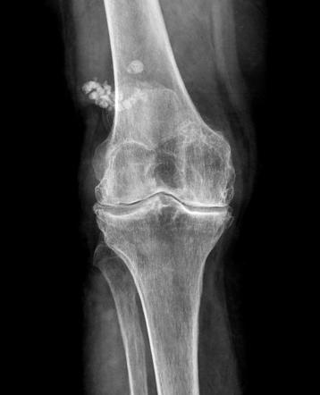 Synovial chondromatosis | Radiology Case | Radiopaedia.org