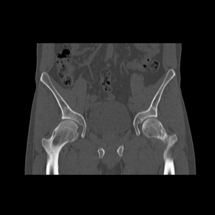 cam type femoroacetabular impingement icd-10