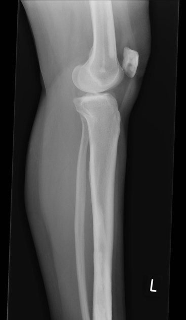 Dripping candle wax sign (melorheostosis), Radiology Reference Article