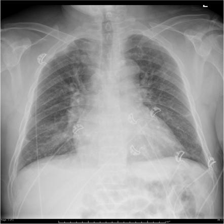 Pulmonary Edema | Radiology Reference Article | Radiopaedia.org