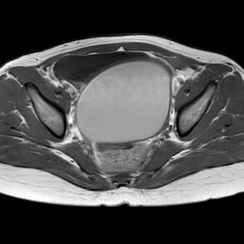 Hematometrocolpos | Image | Radiopaedia.org