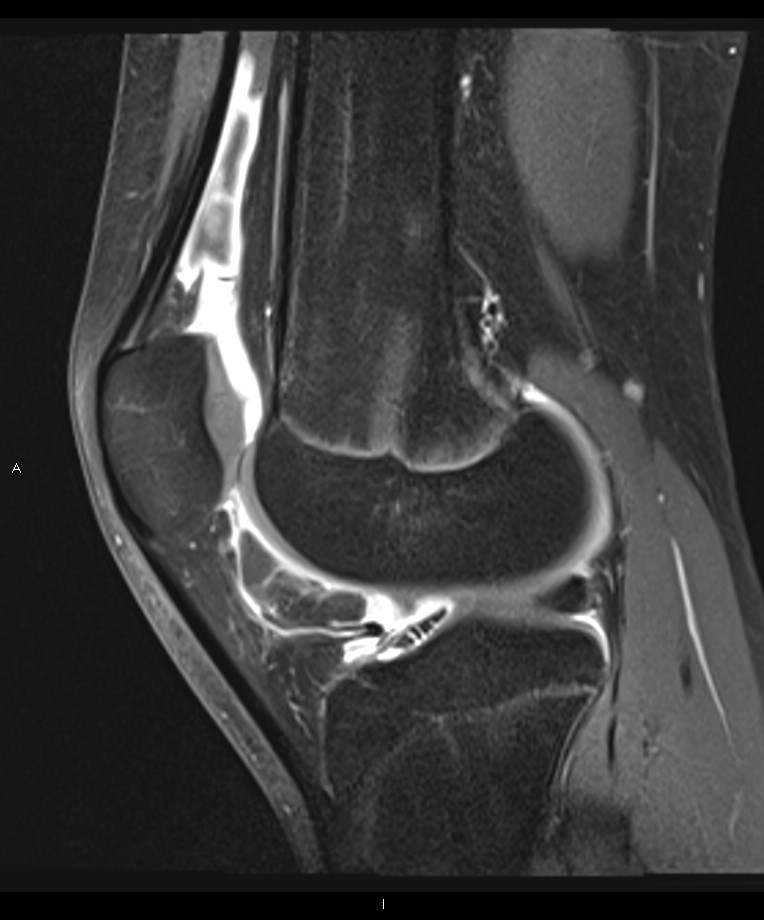 Juvenile idiopathic arthritis | Image | Radiopaedia.org