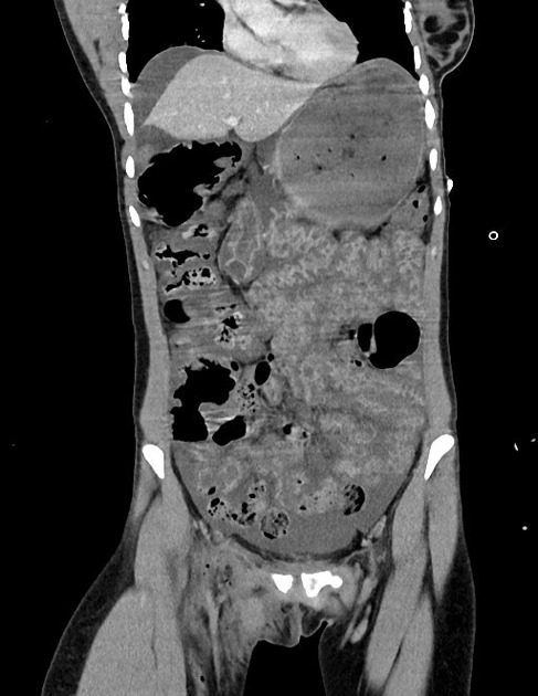 Shock bowel | Radiology Reference Article | Radiopaedia.org