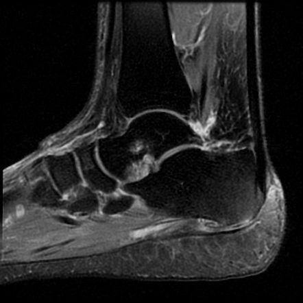 Baxter’s nerve impingement | Image | Radiopaedia.org