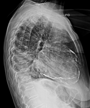 Pericardial calcification | Radiology Reference Article | Radiopaedia.org