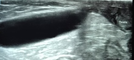 Encysted hydrocele of spermatic cord | Radiology Case | Radiopaedia.org