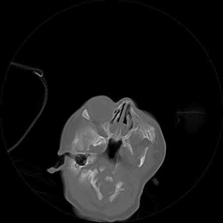 Bilateral choanal atresia | Radiology Case | Radiopaedia.org