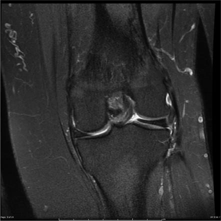 Discoid meniscus | Radiology Reference Article | Radiopaedia.org