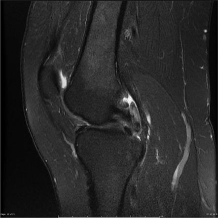 Discoid lateral meniscus and loose body | Radiology Case | Radiopaedia.org