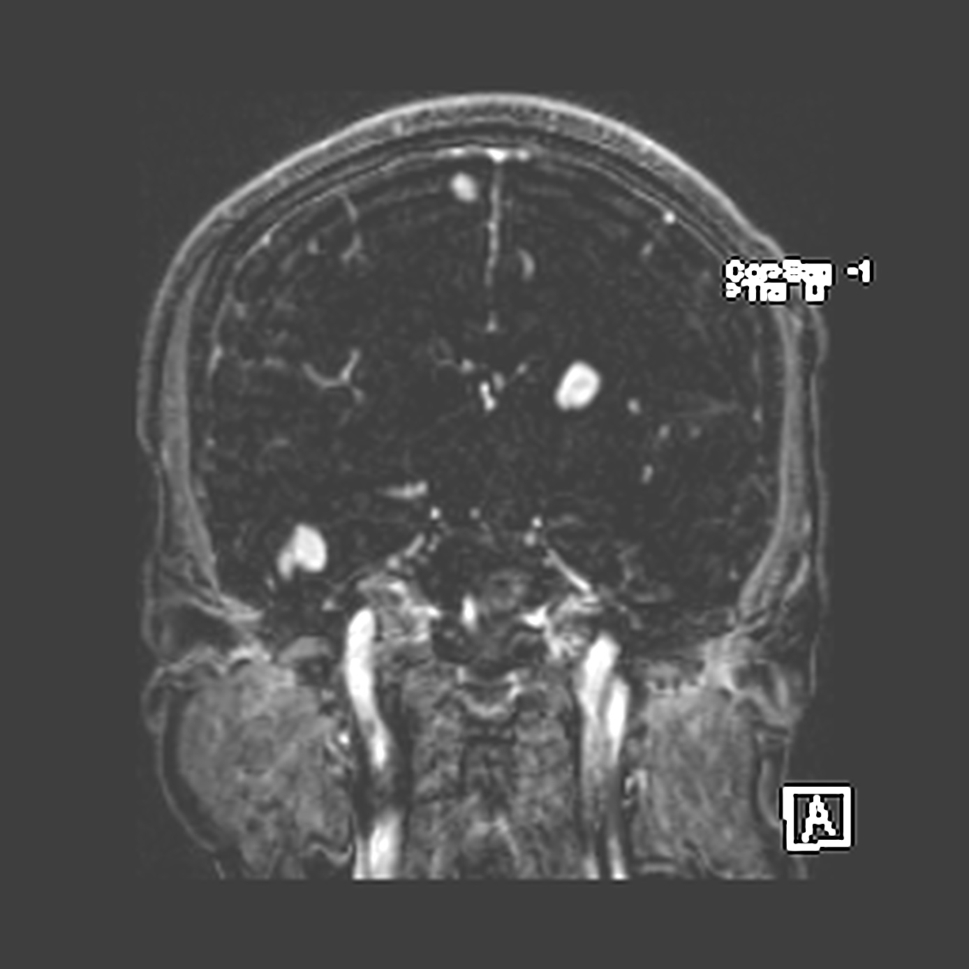 Langerhans Cell Histiocytosis Image