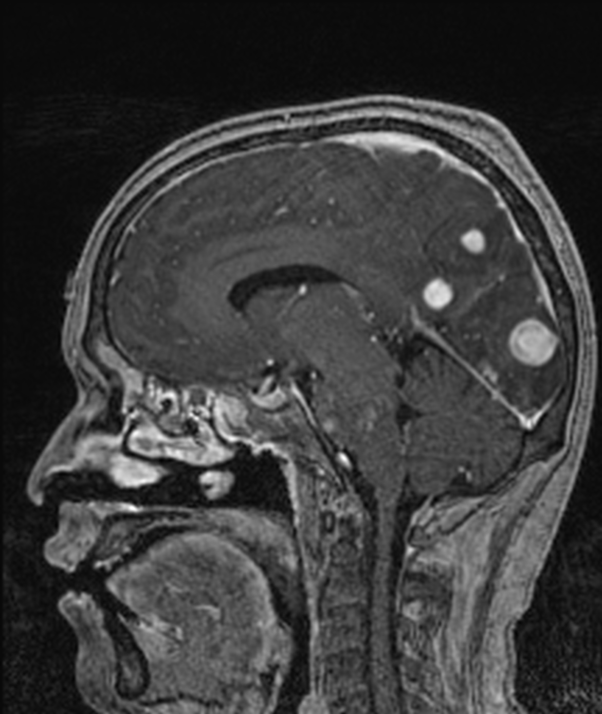 Langerhans Cell Histiocytosis Image