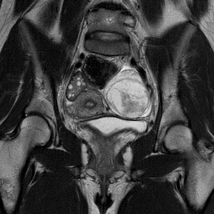 Hemorrhagic ovarian cyst | Image | Radiopaedia.org