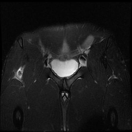 Rectus femoris muscle injury | Radiology Reference Article ...