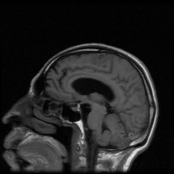 Neurocysticercosis Before And After Treatment | Image | Radiopaedia.org