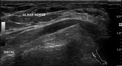 Cubital tunnel syndrome | Radiology Reference Article | Radiopaedia.org