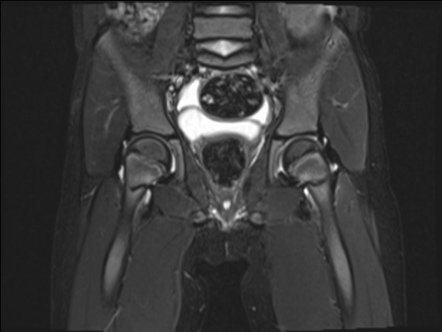 Pseudofractures of bilateral femoral necks | Radiology Case ...