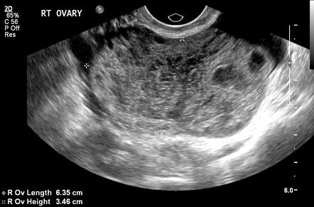 Ovarian torsion | Radiology Reference Article | Radiopaedia.org