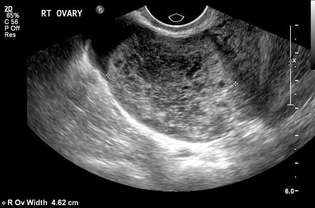 Ovarian Torsion Ultrasound Findings