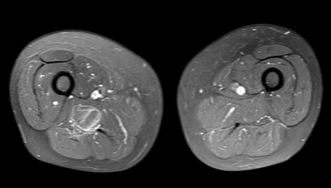 Atypical lipomatous tumor - thigh | Image | Radiopaedia.org