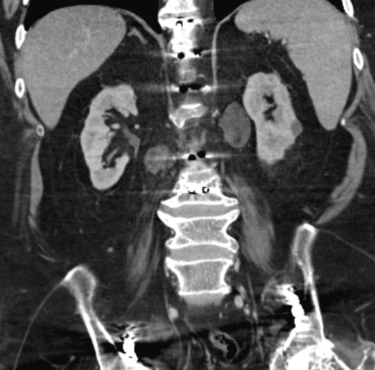 Adrenal myelolipoma and extra-adrenal myelolipoma | Image | Radiopaedia.org