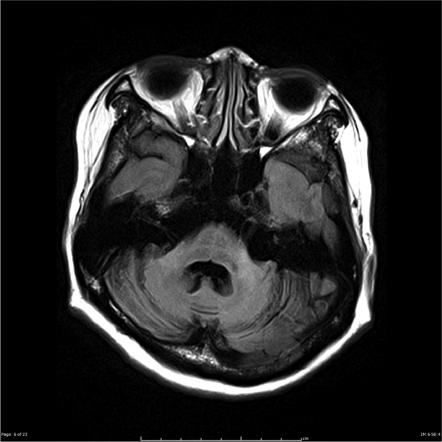 Multiple System Atrophy | Radiology Reference Article | Radiopaedia.org